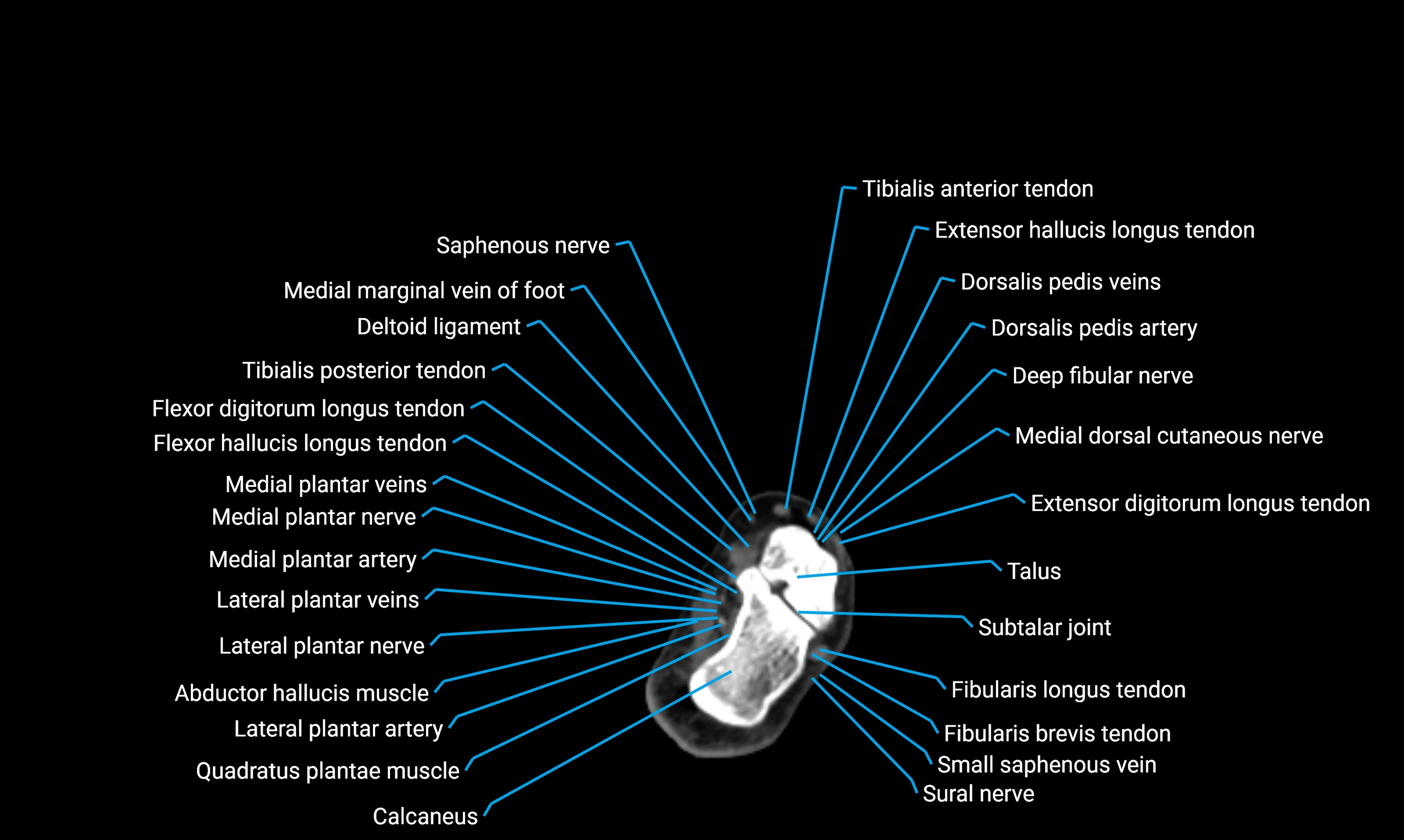 CT lower limb axial cross sectional anatomy labelled image 171 (2).webp